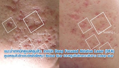 แนะนำเทคนิคดูแลหลุมสิว: เทคนิค Deep Focused Ablative Laser (DFA) ดูแลหลุมสิวลึกขอบชัดพังผืดหนา Boxcar Scar และหลุมสิวลักษณะเส้นยาว Linear scar